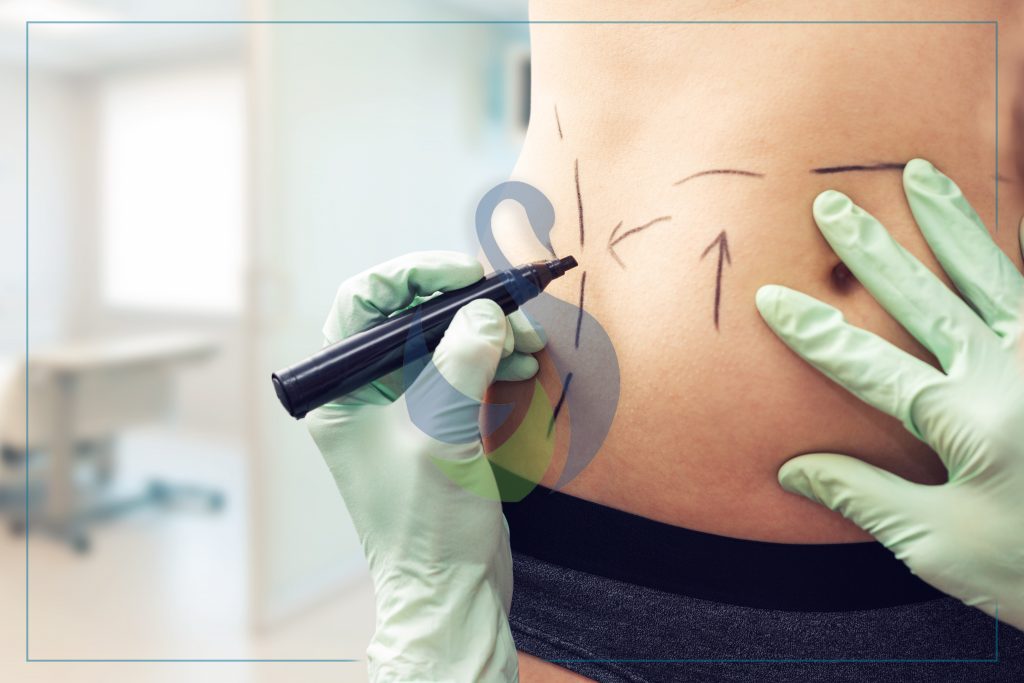 vaser-liposuction-in-turkey